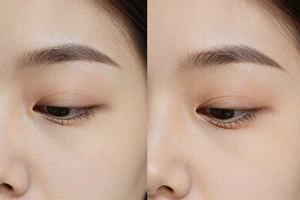 Fine Lines Explained: Causes, Prevention, and Treatment Options