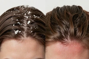 warning signs your dry scalp is a reaction, not just dryness