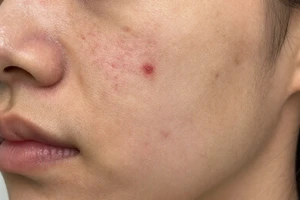 3 warning signs your post-acne marks may need professional treatment