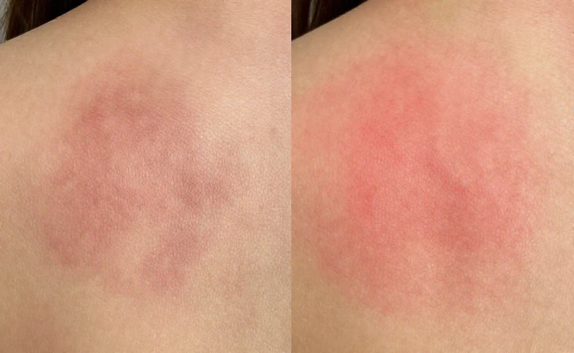 A practical explainer: how post-acne marks form and how to treat them