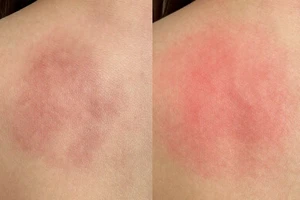 A practical explainer: how post-acne marks form and how to treat them