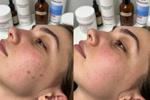 Expert-backed ingredients for treating post-acne marks at home