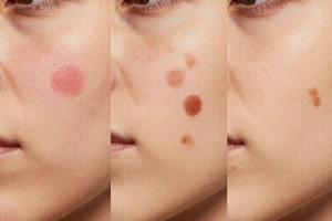 Is it a pimple or a scar? How to identify different post-acne marks