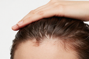 Expert-Backed Scalp Care Adjustments for Managing Excess Oil