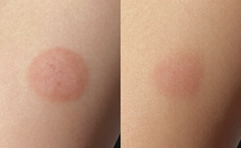 3 Early Warning Signs Your Sun Spots Need a Professional's Attention