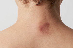 Are You Missing These 3 Subtle Warning Signs of Prediabetes?