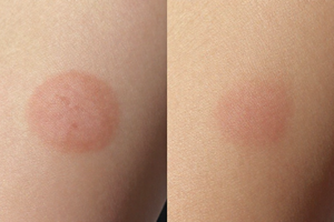 3 Early Warning Signs Your Sun Spots Need a Professional's Attention