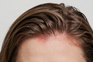 2 Warning Signs Your Scalp Is Reacting to Your Hair Dye