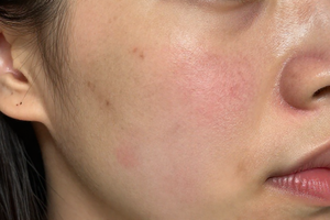 5 Warning Signs Hyperpigmentation Is Getting Worse, Not Fading