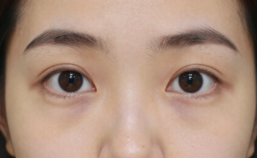 2 Unexpected Symptoms That Point to Deeper Causes of Dark Circles