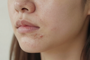 2 subtle signs your acne flare-up could signal a deeper hormone shift