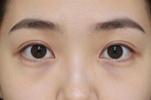 2 Unexpected Symptoms That Point to Deeper Causes of Dark Circles