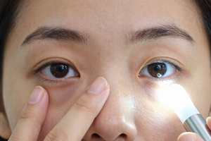 5 Warning Signs Your Dark Circles Need a Dermatologist’s Look