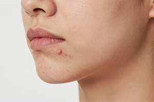 A practical explainer of PCOS acne: why it happens and what helps