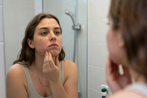 3 habits to avoid if PCOS acne keeps flaring up despite treatment