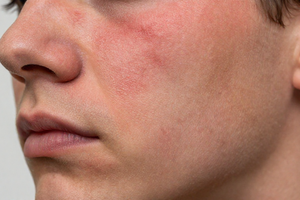 3 Red Flags Your Retinoid Dosage Is Too Strong for Your Skin Type