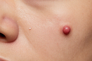 2 symptoms that distinguish cystic acne from a regular pimple