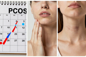 5 subtle symptoms of PCOS beyond irregular periods women often miss
