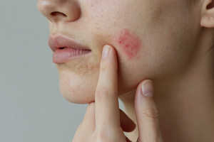 Why picking cystic acne leaves scars — and 2 habits to break now