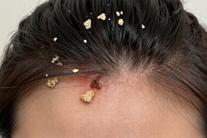 3 warning signs your dandruff is getting worse, not better