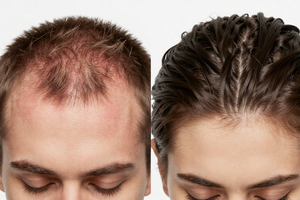 2 symptom changes that mean your scalp needs a new routine