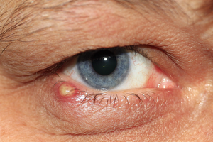 3 inflammation markers endocrinologists check for PCOS diabetes risk